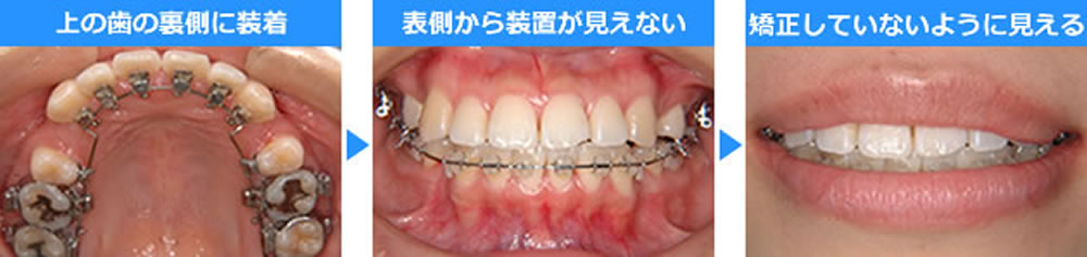裏側矯正