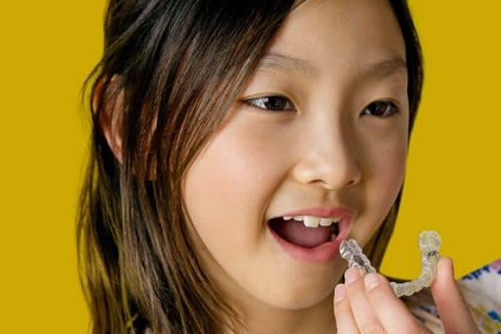 子どものインビザライン